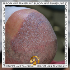 AVRUPA SAÇ EKİMİ - AVRUPA HAİR TRANSPLANT.|Greffe de Cheveux Turquie | Trasplante Capilar Turquia | Пересадка Волос в Турции
