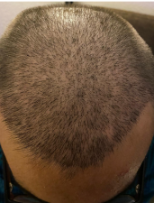 Hermest Hair Clinic | Hair Transplant Turkey Istanbul